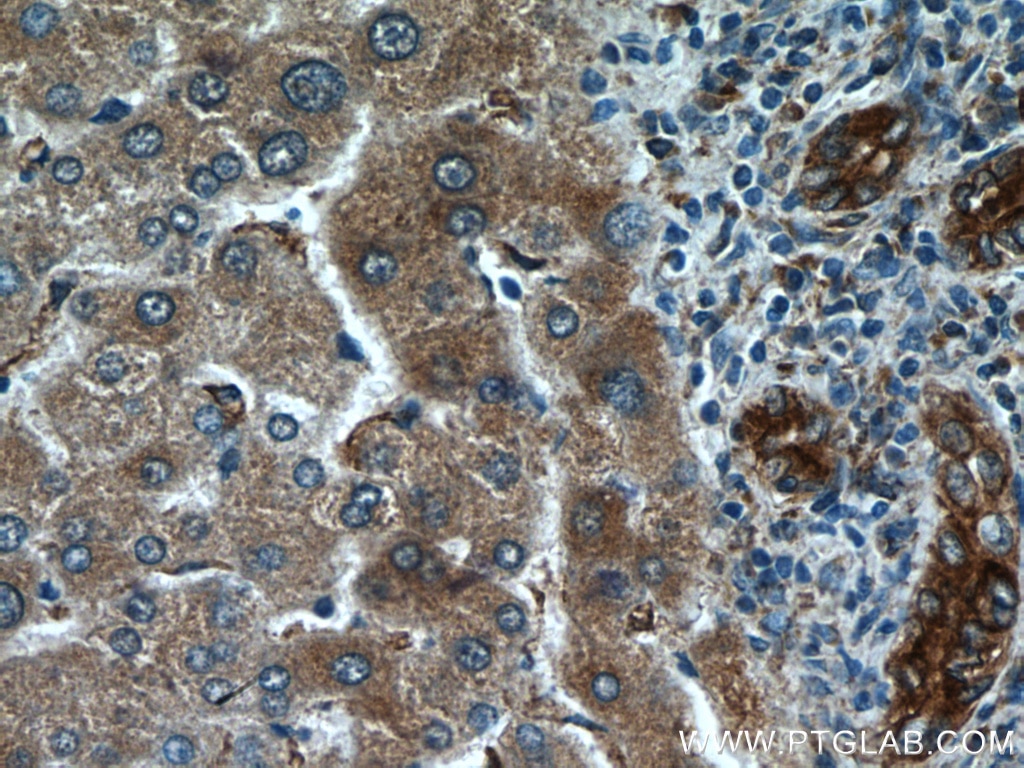 Immunohistochemistry (IHC) staining of human liver cancer tissue using PDIA6 Monoclonal antibody (66669-1-Ig)