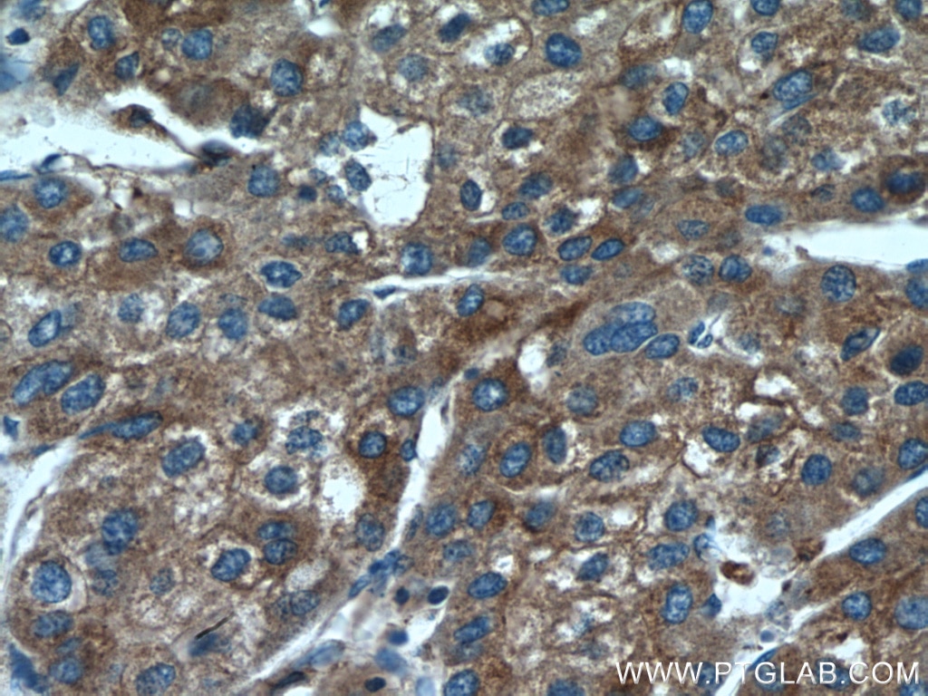 Immunohistochemistry (IHC) staining of human liver cancer tissue using PDIA6 Monoclonal antibody (66669-1-Ig)