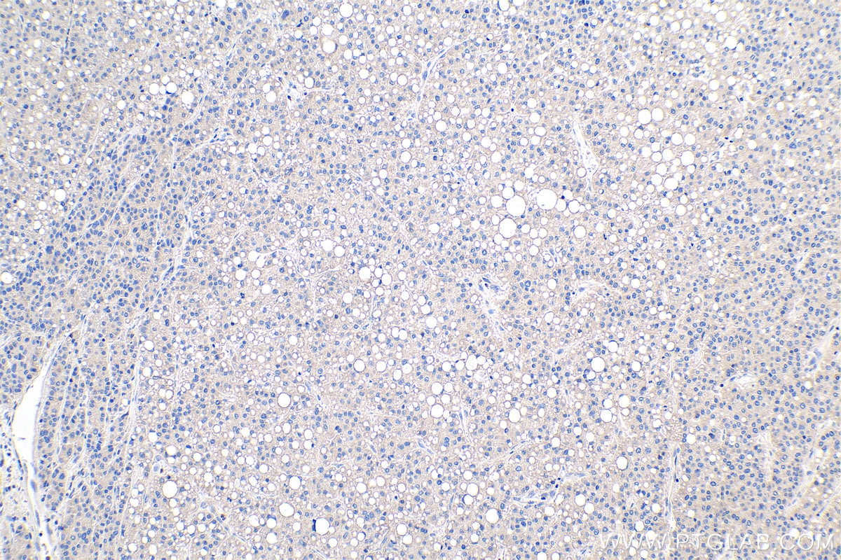 Immunohistochemistry (IHC) staining of human liver cancer tissue using PDK1 Polyclonal antibody (18262-1-AP)
