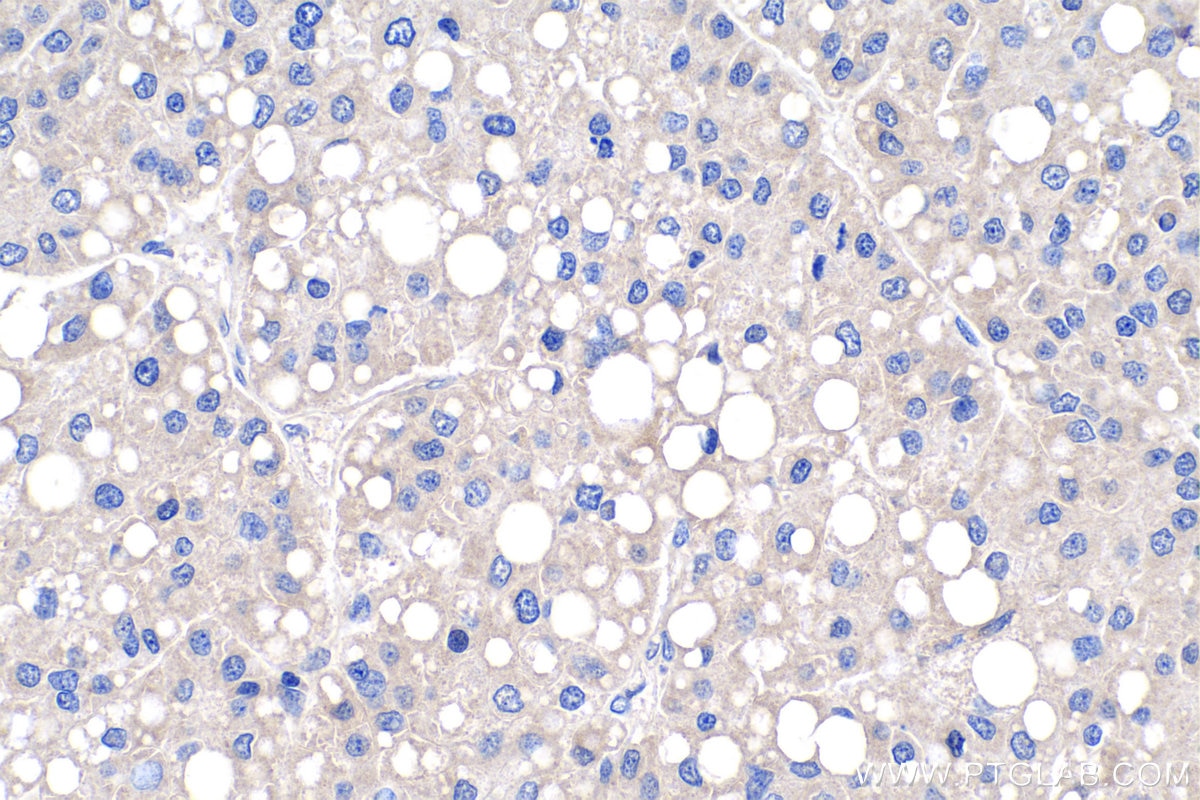 Immunohistochemistry (IHC) staining of human liver cancer tissue using PDK1 Polyclonal antibody (18262-1-AP)