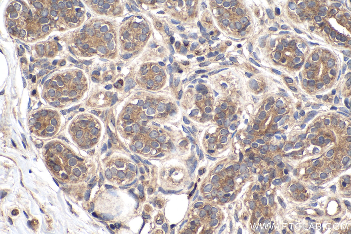 Immunohistochemistry (IHC) staining of human breast cancer tissue using PDK1 Polyclonal antibody (18262-1-AP)