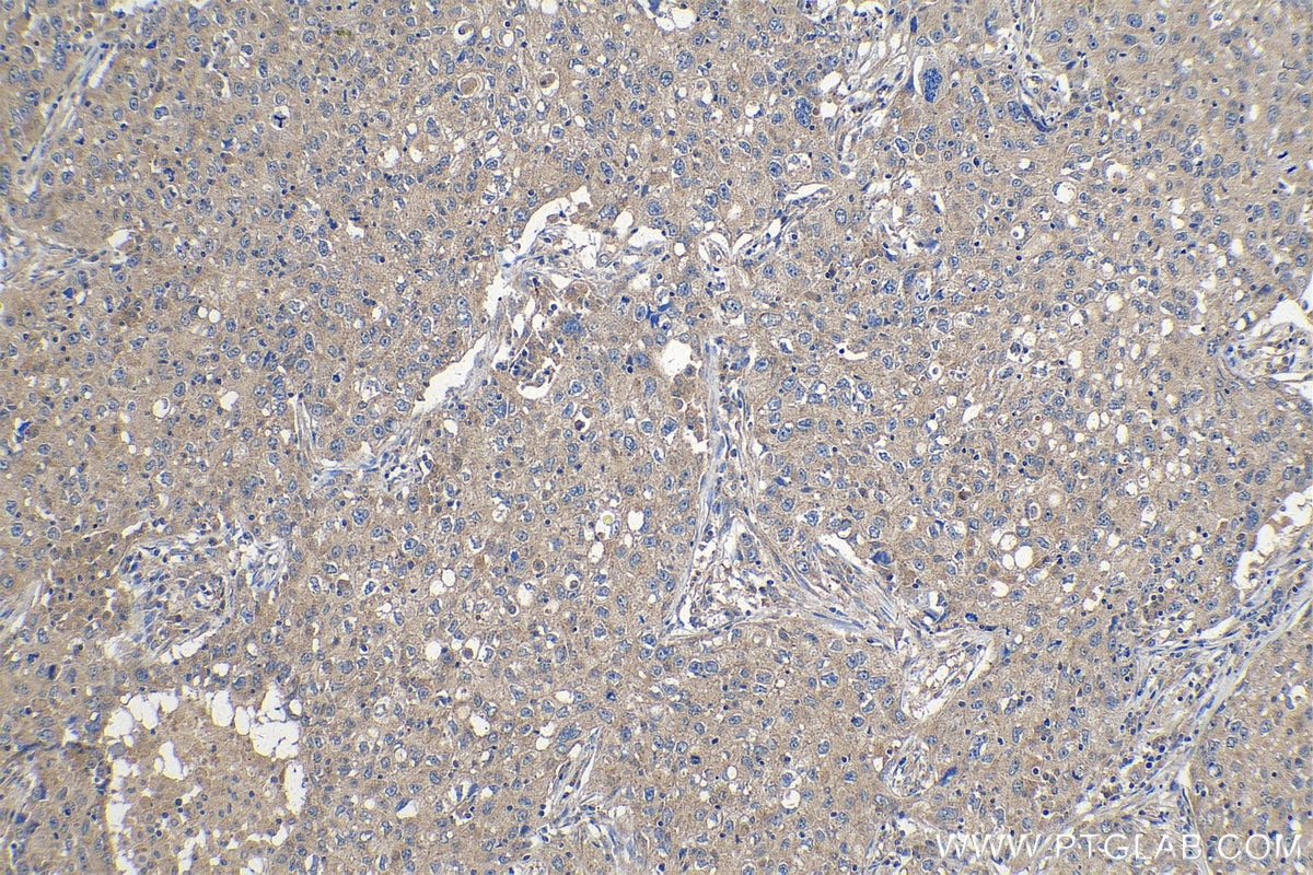 Immunohistochemistry (IHC) staining of human lung cancer tissue using PDK4 Polyclonal antibody (12949-1-AP)
