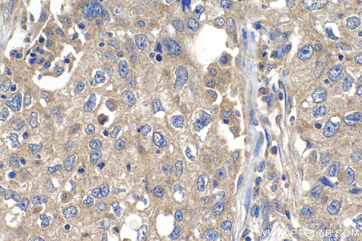 Immunohistochemistry (IHC) staining of human lung cancer tissue using PDK4 Polyclonal antibody (12949-1-AP)