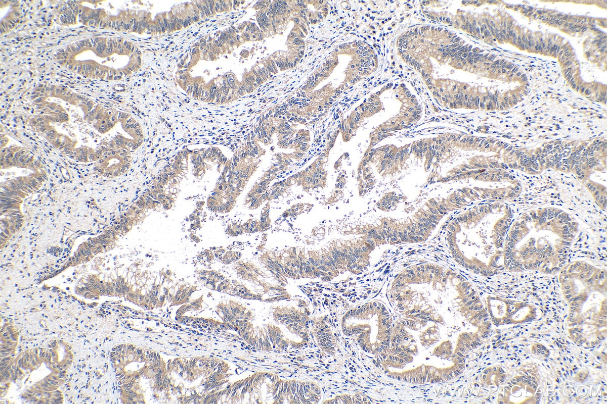 IHC staining of human pancreas cancer using 12949-1-AP