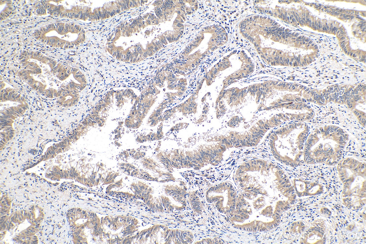 Immunohistochemistry (IHC) staining of human pancreas cancer tissue using PDK4 Polyclonal antibody (12949-1-AP)