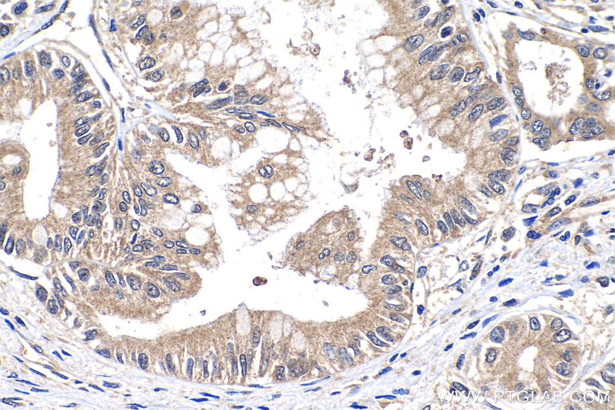 Immunohistochemistry (IHC) staining of human pancreas cancer tissue using PDK4 Polyclonal antibody (12949-1-AP)