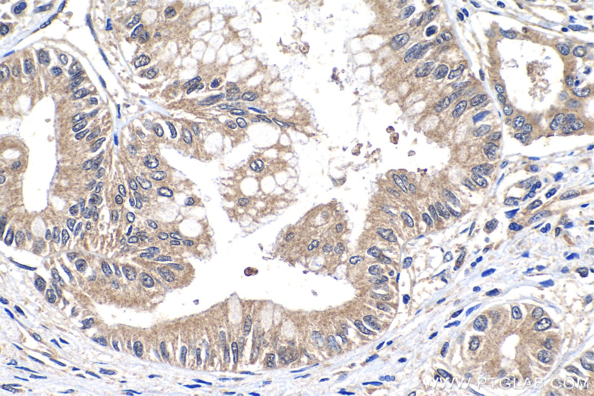 IHC staining of human pancreas cancer using 12949-1-AP