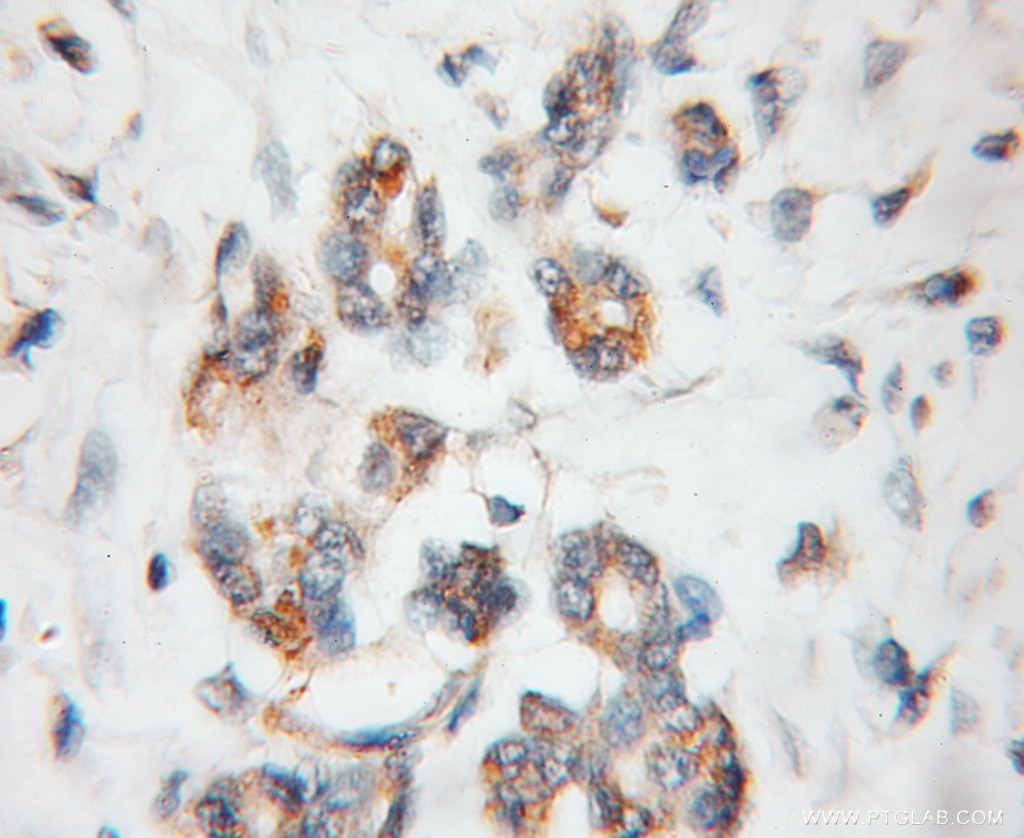 IHC staining of human pancreas cancer using 11674-1-AP