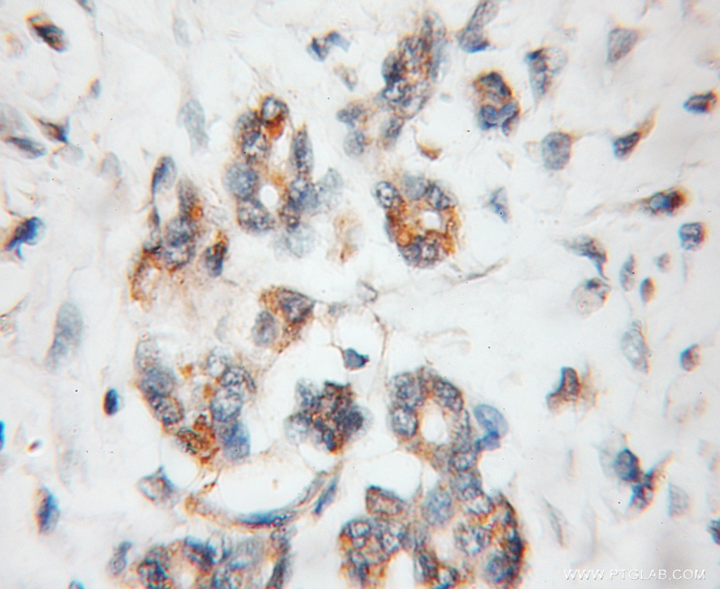 Immunohistochemistry (IHC) staining of human pancreas cancer tissue using PDLIM1/CLP36 Polyclonal antibody (11674-1-AP)