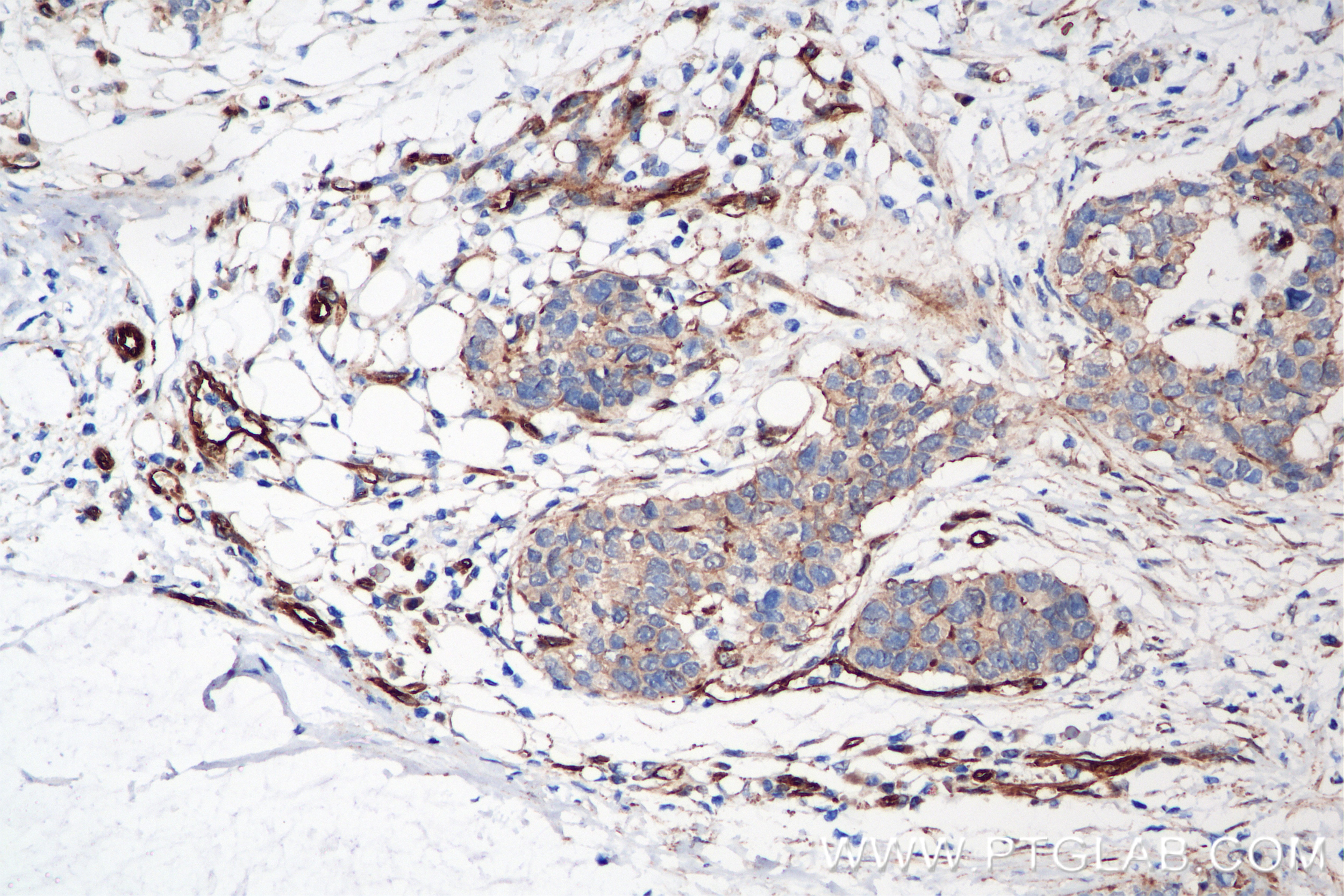 Immunohistochemistry (IHC) staining of human stomach cancer tissue using PDLIM1/CLP36 Recombinant antibody (85027-5-RR)