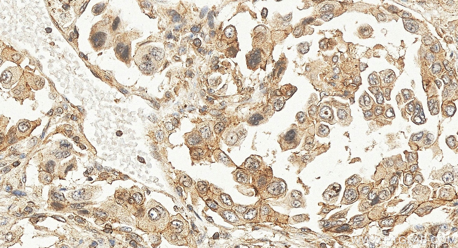 IHC staining of human lung cancer using 11574-1-AP Immunohistochemistry (IHC) staining of human lung cancer tissue using PDLIM2 Polyclonal antibody (11574-1-AP)