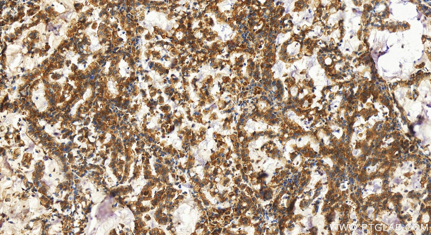 Immunohistochemistry (IHC) staining of human stomach cancer tissue using PDLIM5 Polyclonal antibody (10530-1-AP)
