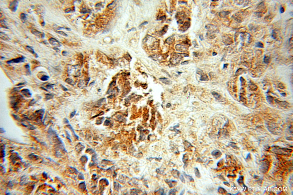 Immunohistochemistry (IHC) staining of human prostate cancer tissue using PDLIM5 Polyclonal antibody (10530-1-AP)