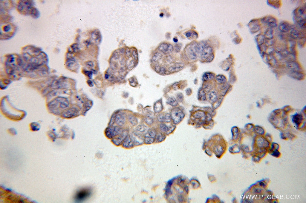 Immunohistochemistry (IHC) staining of human ovary tumor tissue using PDLIM7 Polyclonal antibody (10221-1-AP)