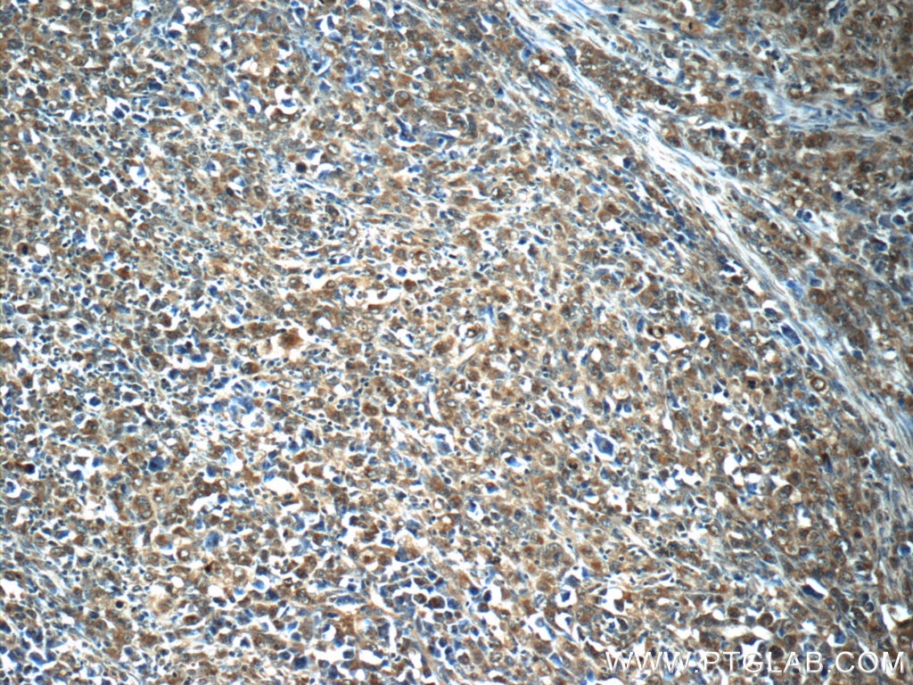 Immunohistochemistry (IHC) staining of human lymphoma tissue using PDP2 Polyclonal antibody (13404-1-AP)