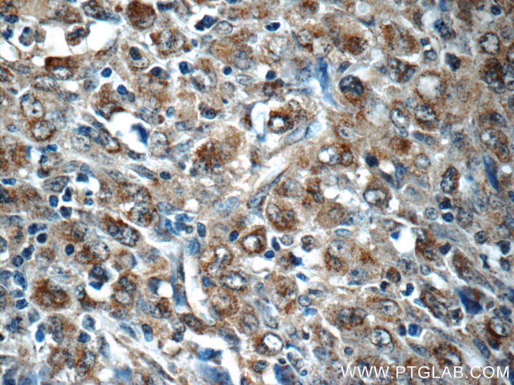 Immunohistochemistry (IHC) staining of human lymphoma tissue using PDP2 Polyclonal antibody (13404-1-AP)