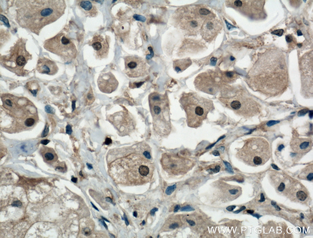 Immunohistochemistry (IHC) staining of human breast cancer tissue using PDPK1 Polyclonal antibody (17086-1-AP)