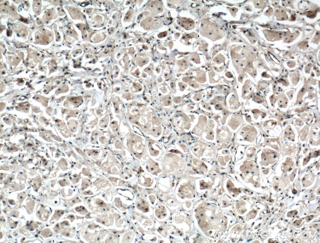 Immunohistochemistry (IHC) staining of human breast cancer tissue using PDPK1 Polyclonal antibody (17086-1-AP)