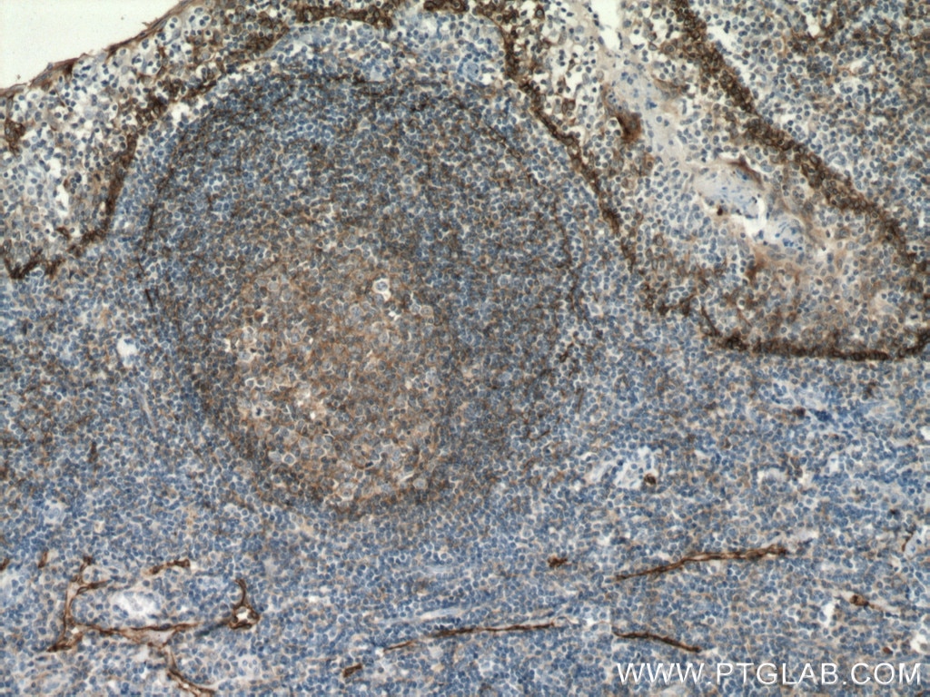 IHC staining of human tonsillitis using 11629-1-AP