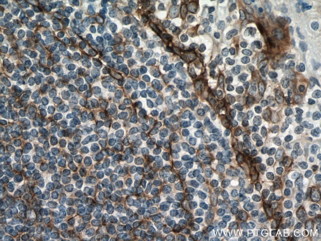 Immunohistochemistry (IHC) staining of human tonsillitis tissue using Podoplanin Polyclonal antibody (11629-1-AP)