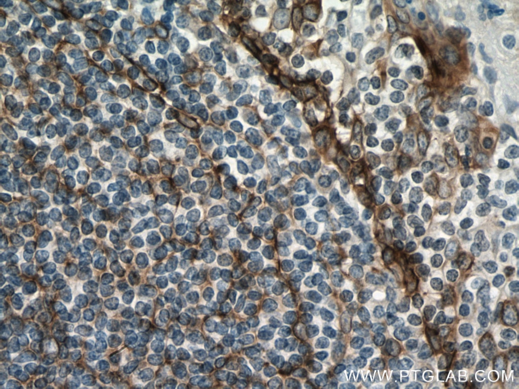 IHC staining of human tonsillitis using 11629-1-AP