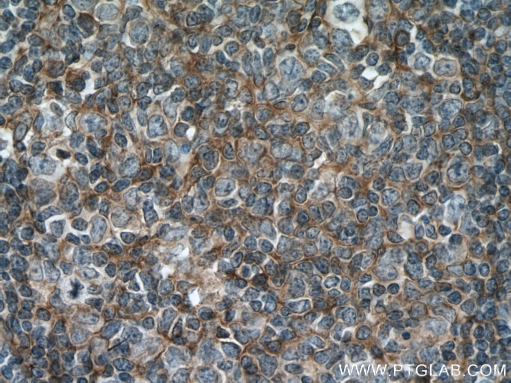 Immunohistochemistry (IHC) staining of human tonsillitis tissue using Podoplanin Polyclonal antibody (11629-1-AP)