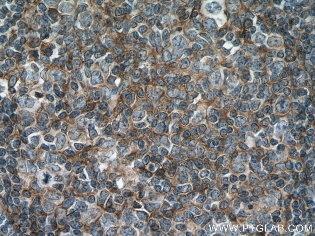 IHC staining of human tonsillitis using 11629-1-AP