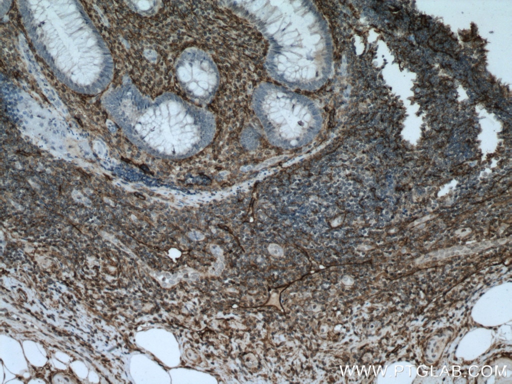 Immunohistochemistry (IHC) staining of human appendicitis tissue using Podoplanin Polyclonal antibody (11629-1-AP)