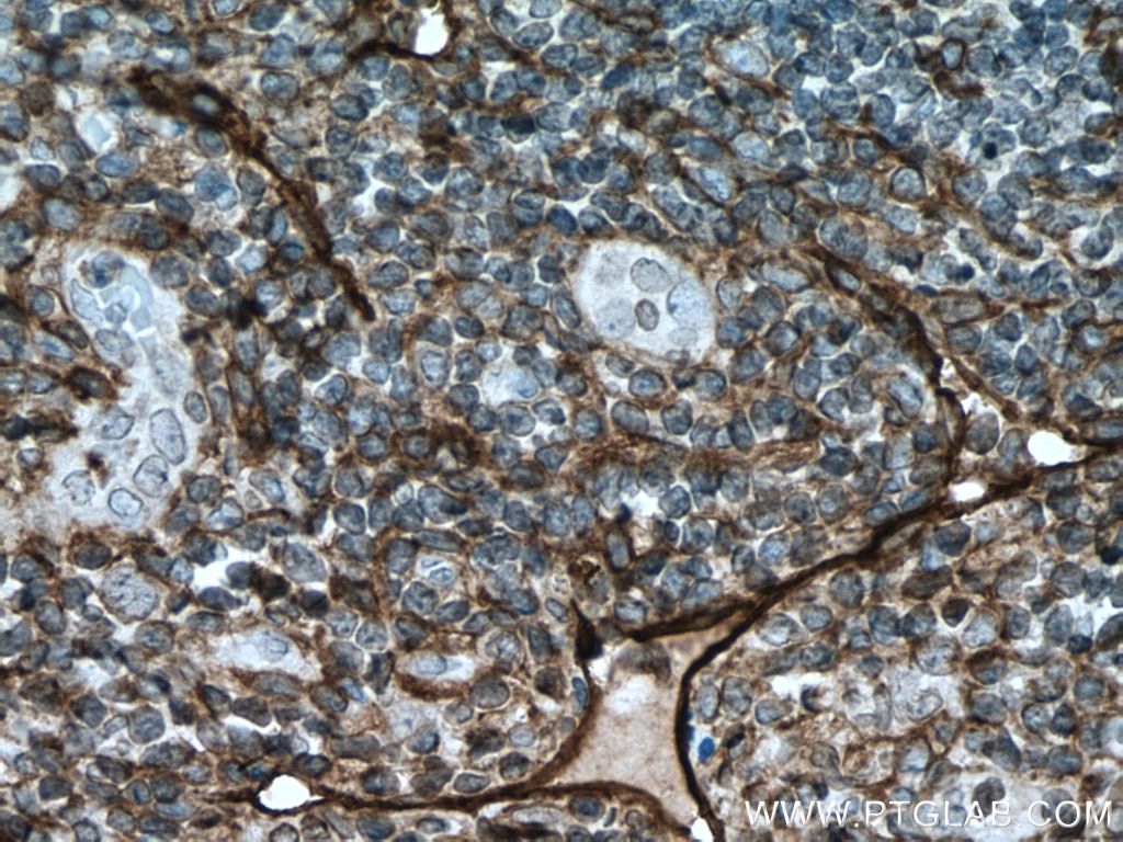 Immunohistochemistry (IHC) staining of human appendicitis tissue using Podoplanin Polyclonal antibody (11629-1-AP)