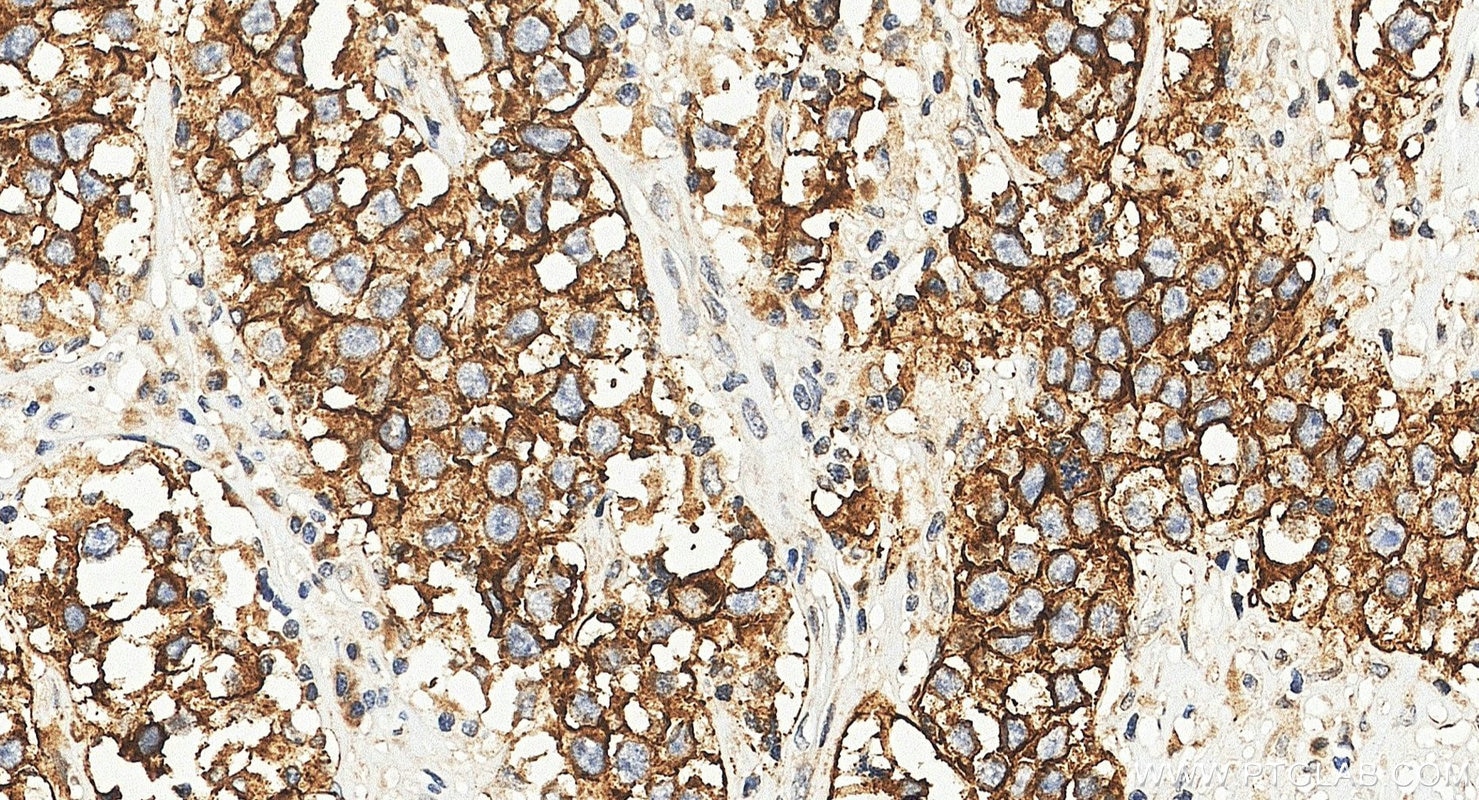 IHC staining of human seminoma using 11629-1-AP Immunohistochemistry (IHC) staining of human seminoma tissue using Podoplanin Polyclonal antibody (11629-1-AP)