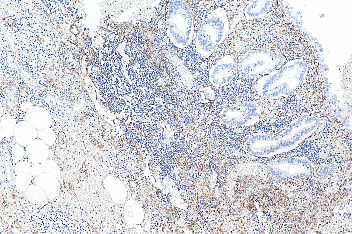 Immunohistochemistry (IHC) staining of human appendicitis tissue using Podoplanin Polyclonal antibody (22099-1-AP)