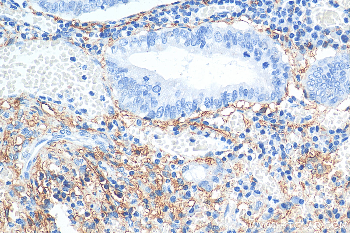 Immunohistochemistry (IHC) staining of human appendicitis tissue using Podoplanin Polyclonal antibody (22099-1-AP)