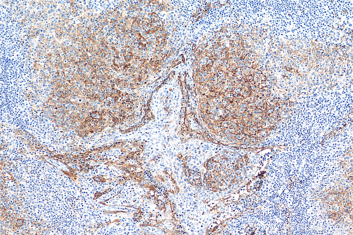 IHC staining of human lymphoma using 22099-1-AP