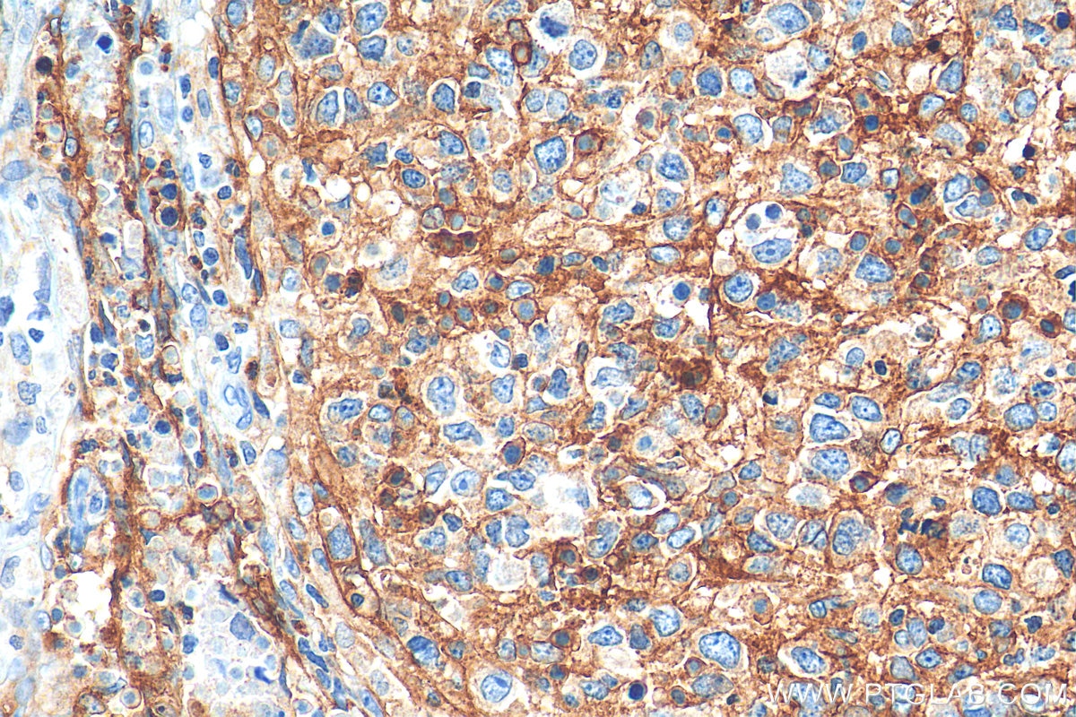 Immunohistochemistry (IHC) staining of human lymphoma tissue using Podoplanin Polyclonal antibody (22099-1-AP)