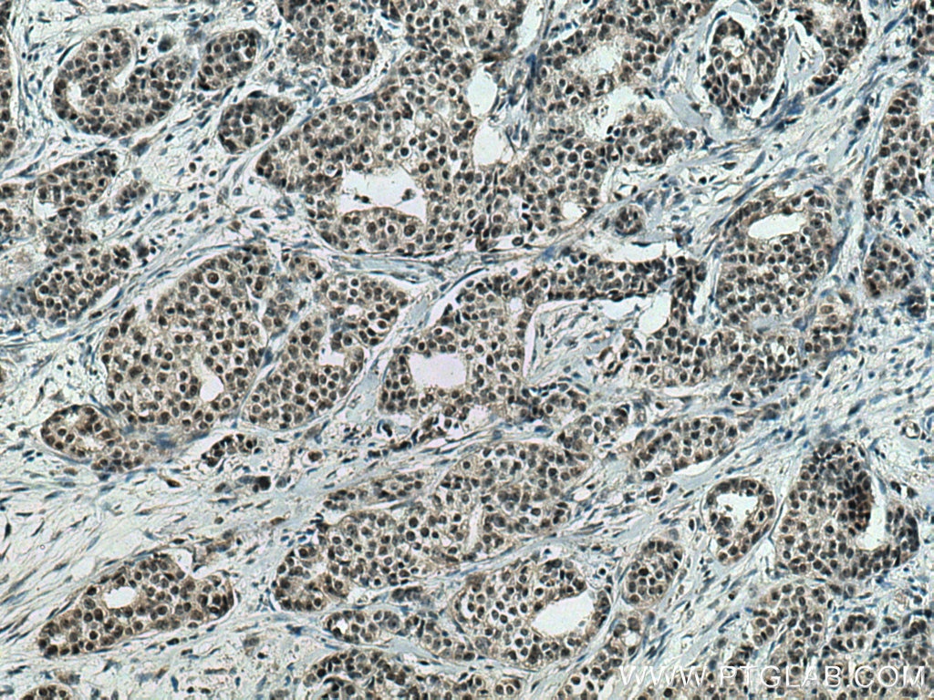 Immunohistochemistry (IHC) staining of human breast cancer tissue using PDS5A Monoclonal antibody (67520-1-Ig)
