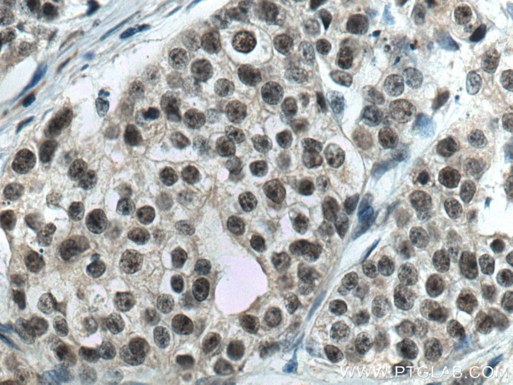 Immunohistochemistry (IHC) staining of human breast cancer tissue using PDS5A Monoclonal antibody (67520-1-Ig)