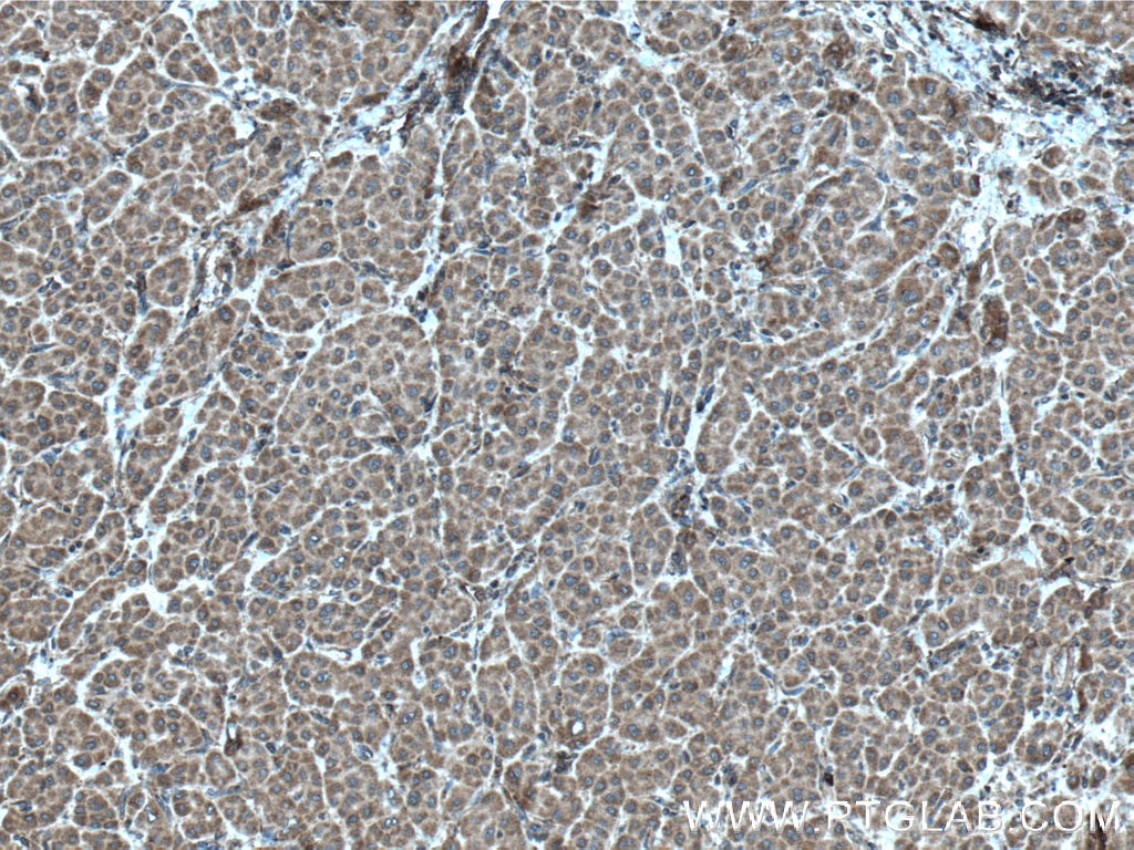 Immunohistochemistry (IHC) staining of human liver cancer tissue using PDSS2 Polyclonal antibody (13544-1-AP)