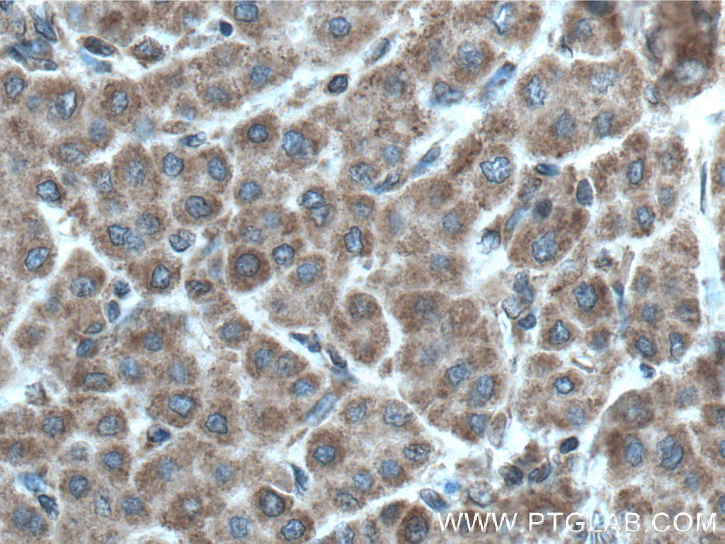 Immunohistochemistry (IHC) staining of human liver cancer tissue using PDSS2 Polyclonal antibody (13544-1-AP)
