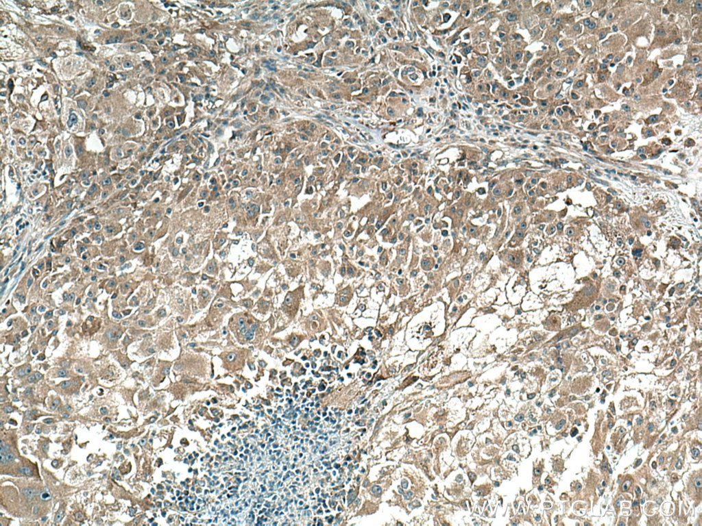 Immunohistochemistry (IHC) staining of human liver cancer tissue using PDSS2 Polyclonal antibody (13544-1-AP)