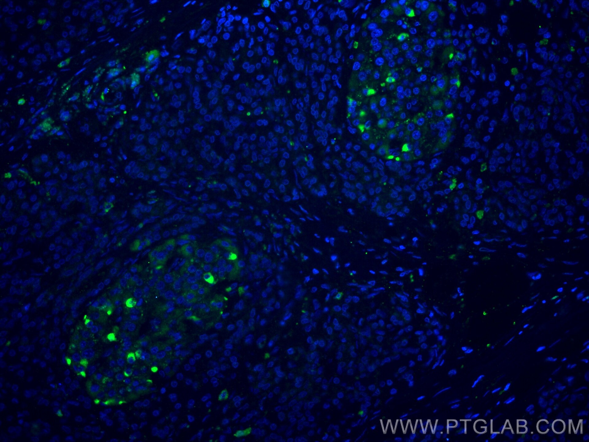 Immunofluorescence (IF) / fluorescent staining of human pancreas cancer tissue using PDX1 Polyclonal antibody (20989-1-AP)