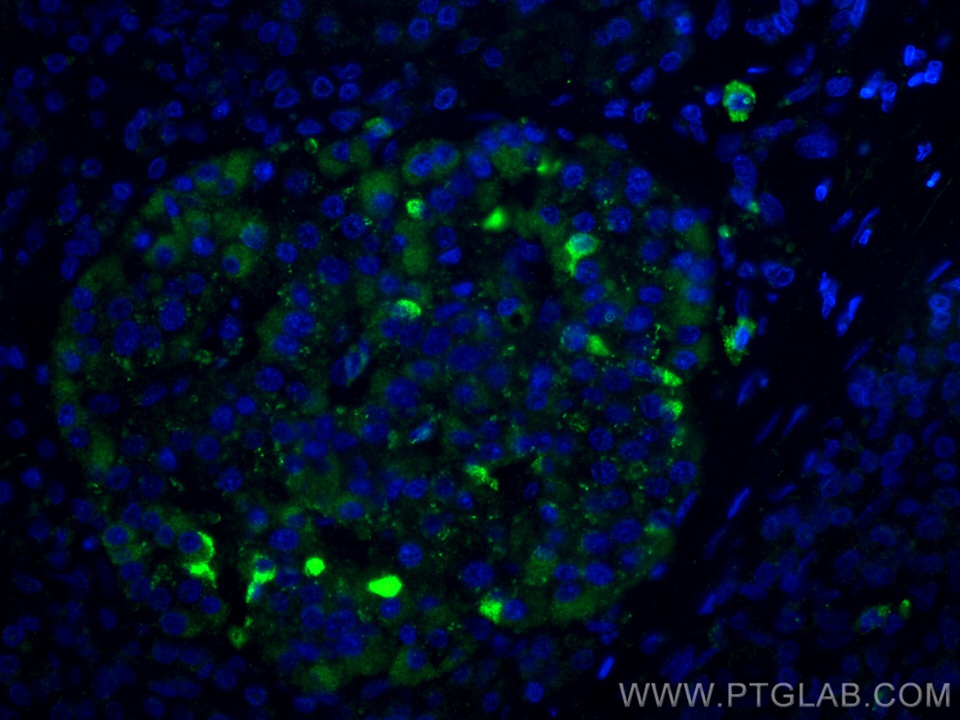Immunofluorescence (IF) / fluorescent staining of human pancreas cancer tissue using PDX1 Polyclonal antibody (20989-1-AP)