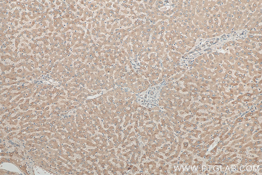 Immunohistochemistry (IHC) staining of human hepatocirrhosis tissue using PDXDC1 Polyclonal antibody (21021-1-AP)