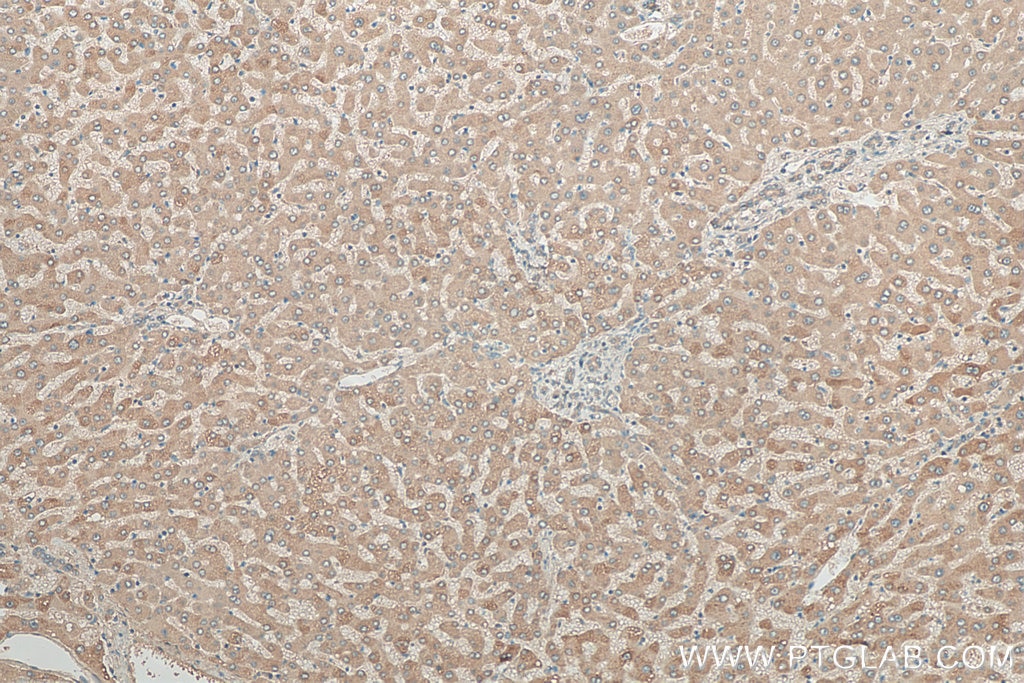 IHC staining of human hepatocirrhosis using 21021-1-AP