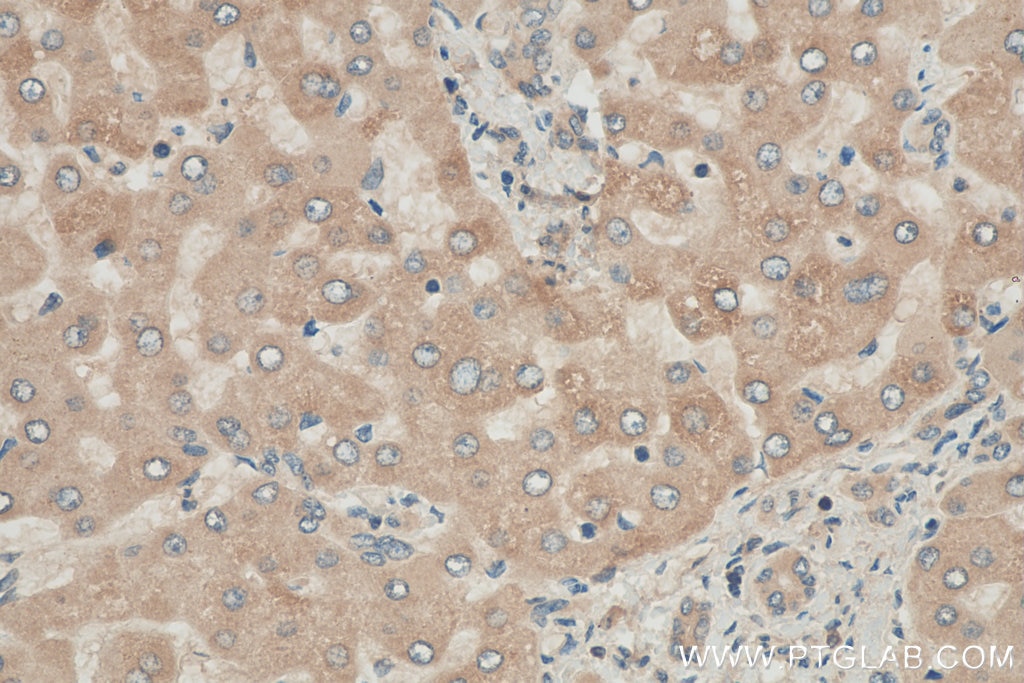 IHC staining of human hepatocirrhosis using 21021-1-AP