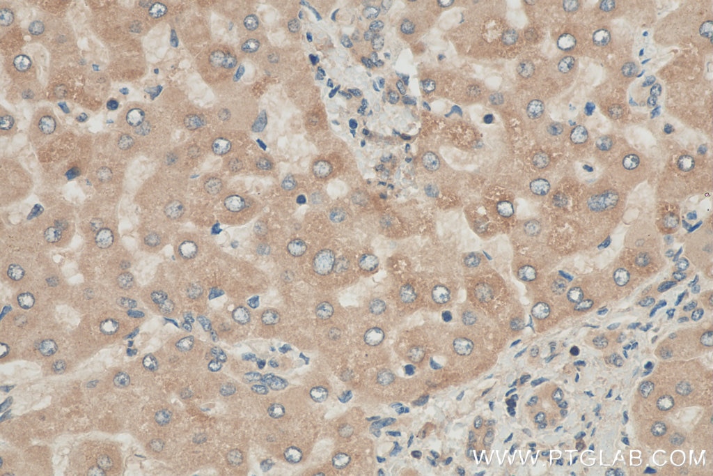 Immunohistochemistry (IHC) staining of human hepatocirrhosis tissue using PDXDC1 Polyclonal antibody (21021-1-AP)