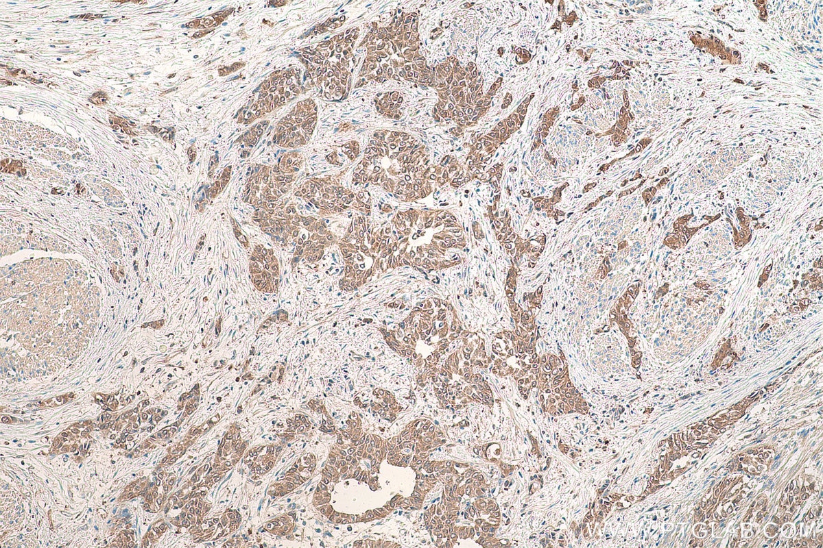 Immunohistochemistry (IHC) staining of human urothelial carcinoma tissue using PDXK Polyclonal antibody (15309-1-AP)