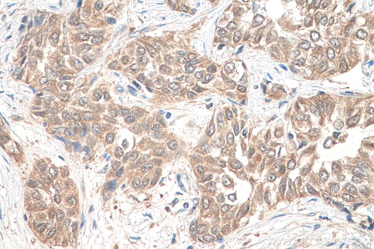 Immunohistochemistry (IHC) staining of human urothelial carcinoma tissue using PDXK Polyclonal antibody (15309-1-AP)