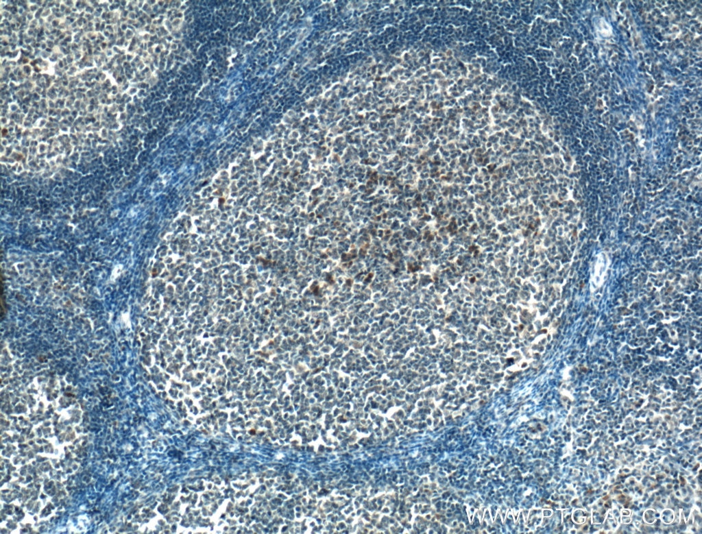 Immunohistochemistry (IHC) staining of human tonsillitis tissue using PDXP Polyclonal antibody (27490-1-AP)