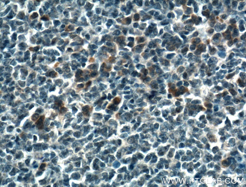 Immunohistochemistry (IHC) staining of human tonsillitis tissue using PDXP Polyclonal antibody (27490-1-AP)