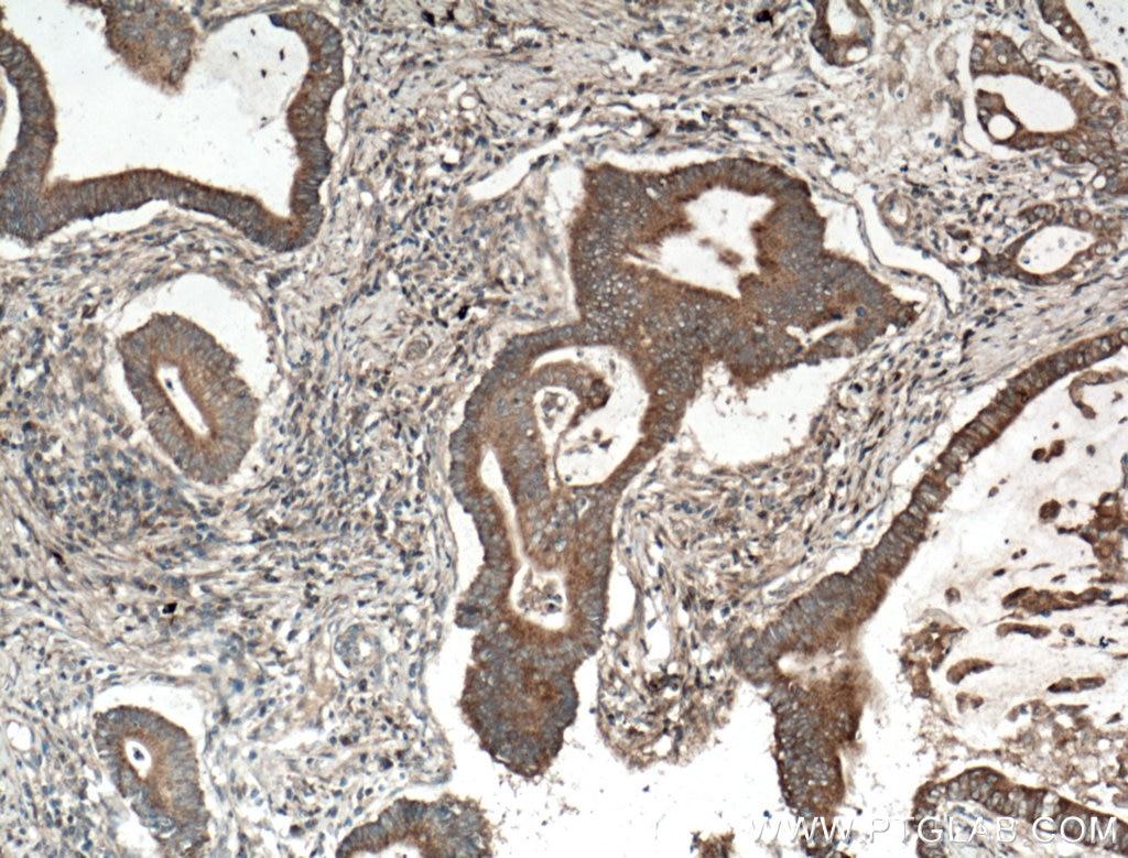 Immunohistochemistry (IHC) staining of human stomach cancer tissue using RKIP Polyclonal antibody (10575-1-AP)